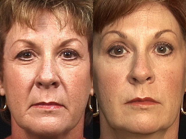 Botox eliminates wrinkles